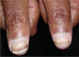 Professionally performed and black line in nail bed pattern on nails can be done not only with the help of brushes, but also with the help of dots. Evaluation Of Nail Abnormalities American Family Physician