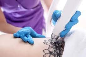 12 Most Frequently Asked Questions from Laser Tattoo Removal Patients