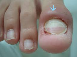 Image result for Paronychia feet