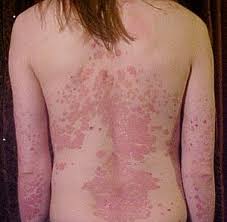 Pathogenesis, risk factors and transmission, classic and crusted types, signs & symptoms, diagnosis and treatment. Psoriasis Wikipedia