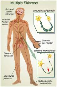 Multiple sklerose, abgekürzt mit ms, in der neurologie auch encephalomyelitis disseminata die ursache, in der fachsprache auch ätiologie genannt, für ms ist zum heutigen zeitpunkt nicht geklärt. Multiple Sklerose Ursachen Beschwerden Therapie Gesundpedia De
