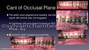 Image result for Occlusal