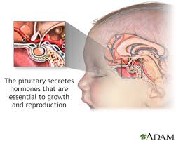Hypogonadotropic Hypogonadism