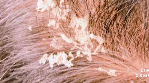Dandruff is usually due to the body's over reaction to the. Biggest Dandruff Flakes Scratching Ever Youtube