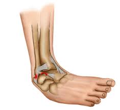 Jenis kaki datar atau flat feet ini merupakan suatu kondisi dimana telapak kaki bersifat datar serta rata dari ujung kaki hingga tumit, tidak adanya lekukan pada dasar kaki. Hati Hati Keseleo Pergelangan Kaki Dapat Memiliki Dampak Buruk Yang Berkepanjangan Surabayaorthopedi Your Bone And Joint Solutions