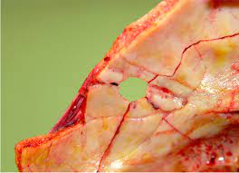 They are more extensive in solid,. Pathology Outlines Gunshot Wounds