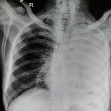 A pneumothorax occurs when air gets into this space between the lung and the inside of the ribs. Cureus Tension Pneumothorax During Rigid Bronchoscopy For Chronic Foreign Body Removal In A Child A Case Report