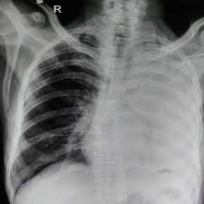 The air then fills the space outside of the lung, between the lung and chest wall. Cureus Tension Pneumothorax During Rigid Bronchoscopy For Chronic Foreign Body Removal In A Child A Case Report