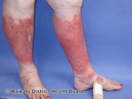 Image result for Lipodermatosclerosis