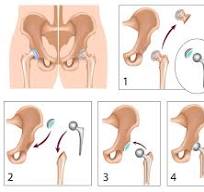 Total Hip Replacement | Robin Orthopaedics Melbourne