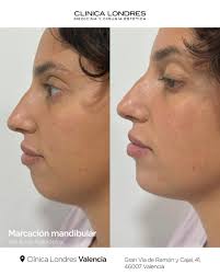 Define y armoniza tu rostro✨⁣ ⁣ En Clínica Londres 📍 Valencia logramos  este espectacular resultado de marcación mandibular con ácido hialurónico  realizado por la Dra. Raquel Carbonell. 💉⁣ ⁣ ✨ Como podéis