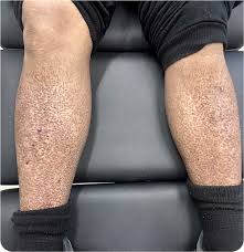 Image result for Pigment stains on the shin