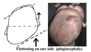 Image result for Positional Head Deformity