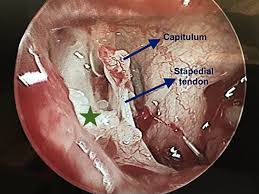 Image result for Ossicular Chain Disruption