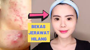 Terkadang harus ditutupi dengan bedak yang tebal, tetapi cara itu kurang baik untuk wajah malah bisa memunculkan kembali jerawat yang baru. 5 Cara Ampuh Menghilangkan Bekas Jerawat Secara Alami Pengalamanku Youtube