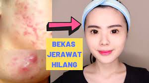 Jerawat adalah satu masalah kulit yang sering terjadi kepada semua kaum tidak kira kaum wanita atau kaum lelaki. 5 Cara Ampuh Menghilangkan Bekas Jerawat Secara Alami Pengalamanku Youtube