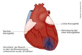Ekg Bei Angina Pectoris Und Herzinfarkt Deximed