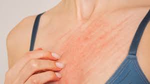 Image result for scabies on humans
