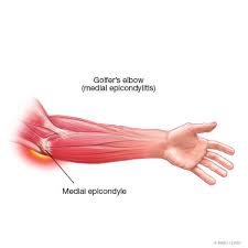 Medial epicondyle apophysitis, often called little league elbow, is the most common injury affecting young baseball pitchers whose bones have not yet what are the symptoms of medial epicondyle apophysitis? Golfer S Elbow Medial Epicondylitis Sports Medicine