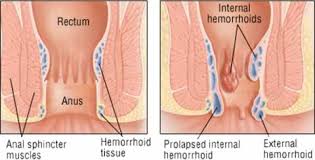 Image result for Hemorrhoid