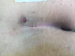 Most pilonidal sinuses become infected when loose hair and debris collect in them. Pilonidal Wound Care Maher A Abbas Md Proctology Colonoscopy
