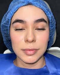 EL PERFILAMIENTO FACIAL. Te presento una secuencia del tratamiento en 6  meses de evolución, el fin de semana le realizamos una RINOMODELACIÓN y  DISEÑO DE LABIOS con ácido hialurónico, como parte del