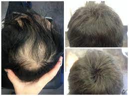 The crown hair loss will widen and get bigger and become more noticeable as time goes on. If Your Hair Loss Begins At The Temples Or The Crown Of The Head You May Have Male Pattern Baldness Bald Baldness Baldnesscure Baldnes Saglik