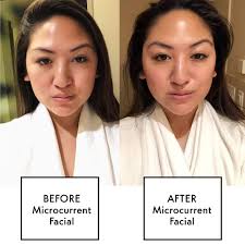 When fluid buildup occurs, it causes how many days are between the before and after photos? What Is A Microcurrent Facial Microcurrent Facial Review Benefits Before And After