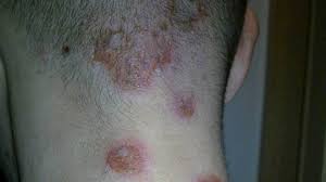 Rash 22 Common Skin Rashes Pictures Causes And Treatment