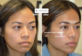Customized Infraorbital Rim Implant Beverly Hills