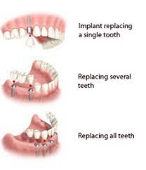 Low Cost Dental Implant Care Contact Us For Free Implant Consultation Dental Implants Cost Tooth Implant Cost Dental Implants