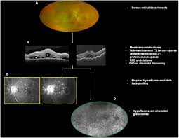 Stepwise approach for fundus imaging in the diagnosis and management of  posterior uveitis - Survey of Ophthalmology
