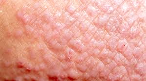 Image result for contact dermatitis