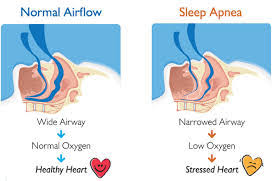 Sleep Apnea And Va Service Connected Compensation