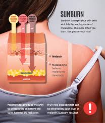 Image result for Sunburn