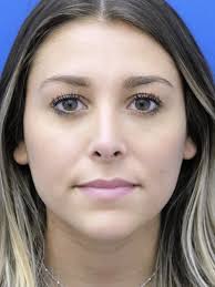 Cases in Rhinoplasty Endonasal