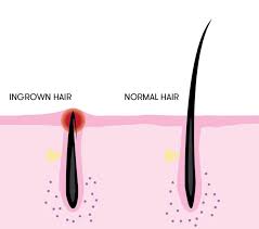 An ingrown hair occurs when a shaved or tweezed hair grows back into the skin. Joe Black Barbershop Treating Ingrown Facial Hairs Joe Black Barbershop