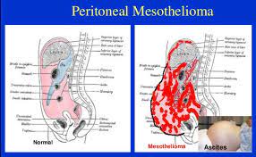 When cancerous tumors form on connective tissues, it is a sarcoma. Peritoneal Mesothelioma Wikitechy