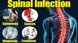 Image result for Spinal Infection