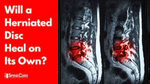 We did not find results for: Will A Herniated Disc Heal On Its Own Surprising Answer Youtube