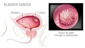 Image result for Bladder Cancer