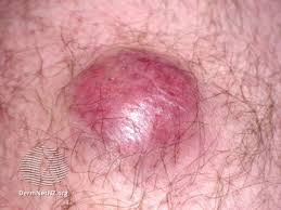 Some types of skin cancer are more dangerous than others, but if you have a spot. Skin Cancer Image Gallery Pictures And Photos