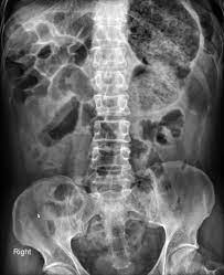 Since trichophagia (compulsive hair sucking, pulling, and swallowing) is the primary cause of trichobezoars, or 'hairballs', appropriate psychiatric treatment can help resolve the issue and prevent a recurrence. Gastric Bezoar Radiology Case Radiopaedia Org