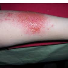 Causes of skin rash in adults and babies. Pdf Phytodermatitis A Brief Review Of Human Skin Reactions Caused By The Kingdom Plantae