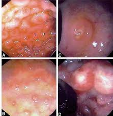 Image result for yersinia fotos