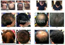Buy toppik hair loss treatments and get the best deals at the lowest prices on ebay! New Packing Men Women Best Toppik Brand Hair Loss Concealer Products Fiber Spray Stlying Powders 27 5g Black Dark Brown 10colors Powder Soup Product Backgroundpowder Container Aliexpress