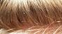 Lice In Hair Vs Dandruff