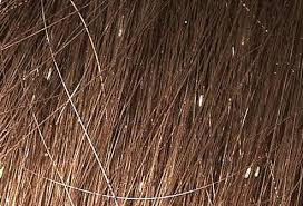 While there are many products available in stores that can help you kill head lice (shampoos, electric combs etc.) the best way to get rid of nits and dead pests is. Lice Nits How To Get Rid Of Head Lice