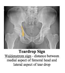 Image result for Hip XRay
