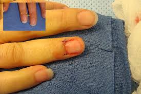 glomus tumor hand surgery source
